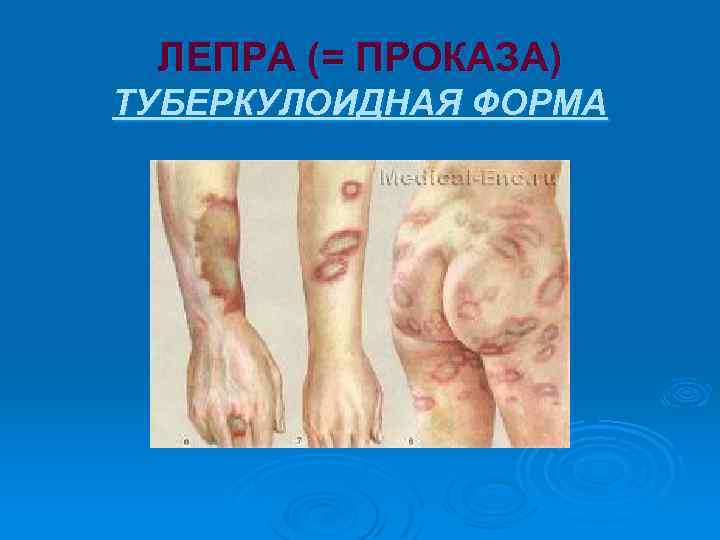 ЛЕПРА (= ПРОКАЗА) ТУБЕРКУЛОИДНАЯ ФОРМА 