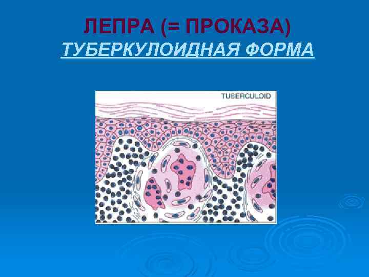 ЛЕПРА (= ПРОКАЗА) ТУБЕРКУЛОИДНАЯ ФОРМА 