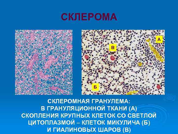 СКЛЕРОМА А В Б СКЛЕРОМНАЯ ГРАНУЛЕМА: В ГРАНУЛЯЦИОННОЙ ТКАНИ (А) СКОПЛЕНИЯ КРУПНЫХ КЛЕТОК СО