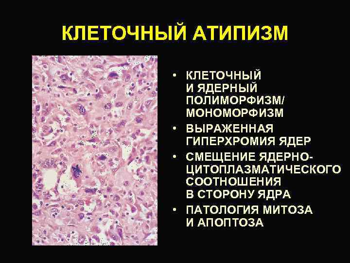 Клетки с гиперхромными ядрами. Тканевой и клеточный атипизм опухолей. Проявления клеточного атипизма опухоли. Признаки клеточного и тканевого атипизма. Атипизм опухоли патанатомия.