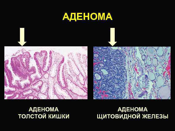 Аденома толстой