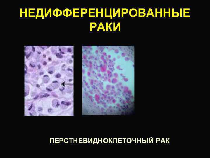 НЕДИФФЕРЕНЦИРОВАННЫЕ РАКИ ПЕРСТНЕВИДНОКЛЕТОЧНЫЙ РАК 