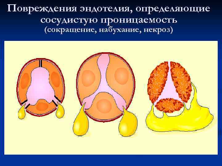 Повреждения эндотелия, определяющие сосудистую проницаемость (сокращение, набухание, некроз) 