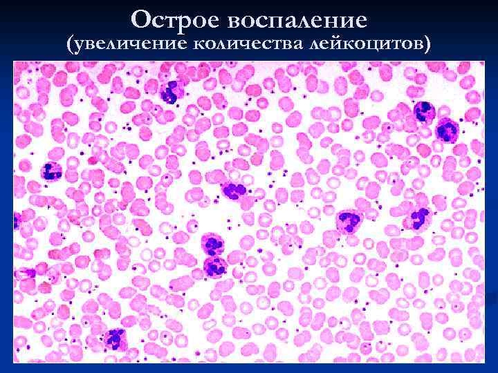 Острое воспаление (увеличение количества лейкоцитов) 