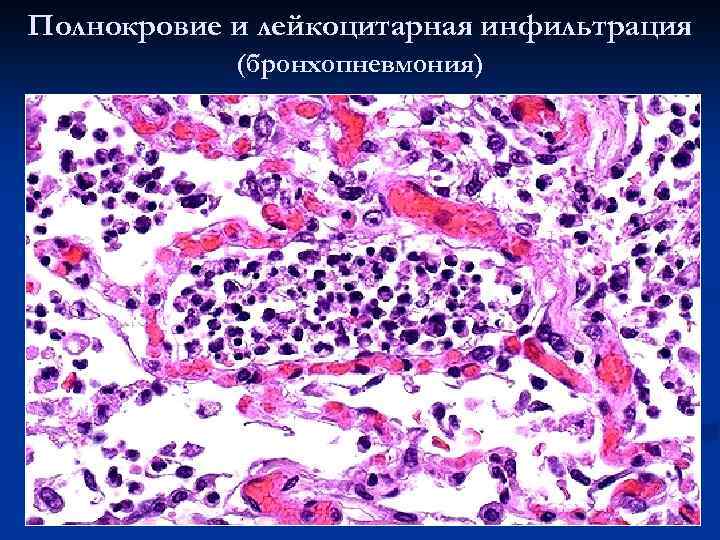 Полнокровие и лейкоцитарная инфильтрация (бронхопневмония) 