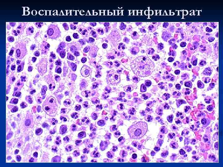 Воспалительный инфильтрат 