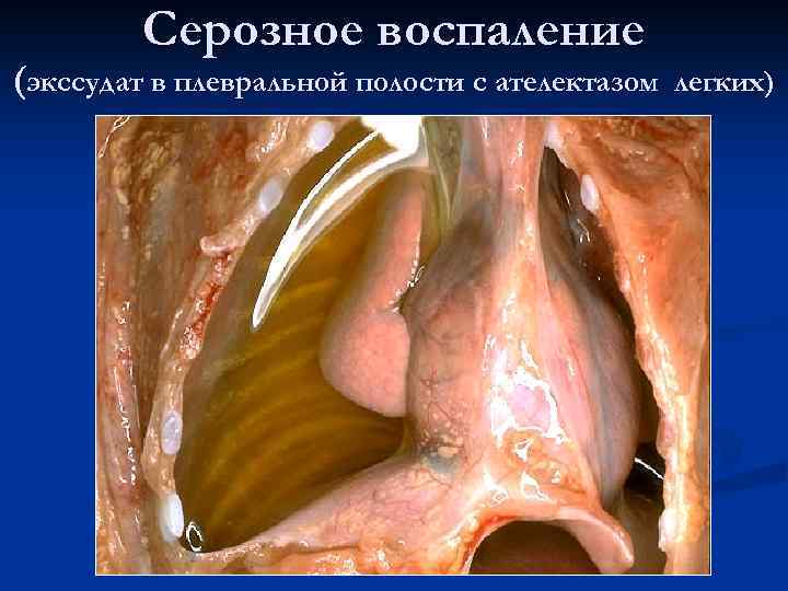 Серозное воспаление (экссудат в плевральной полости с ателектазом легких) 