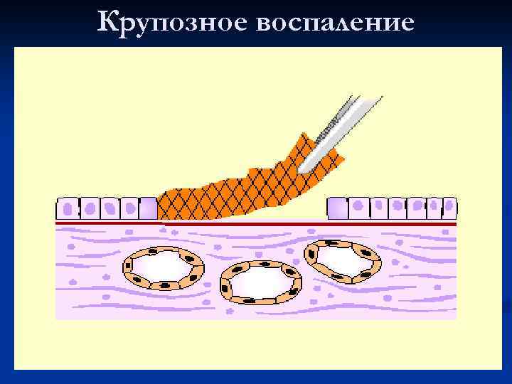 Крупозное воспаление 