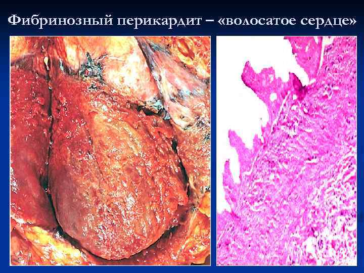 Фибринозный перикардит – «волосатое сердце» 