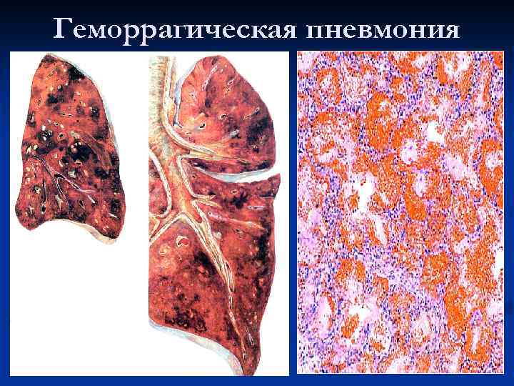 Геморрагическая пневмония 