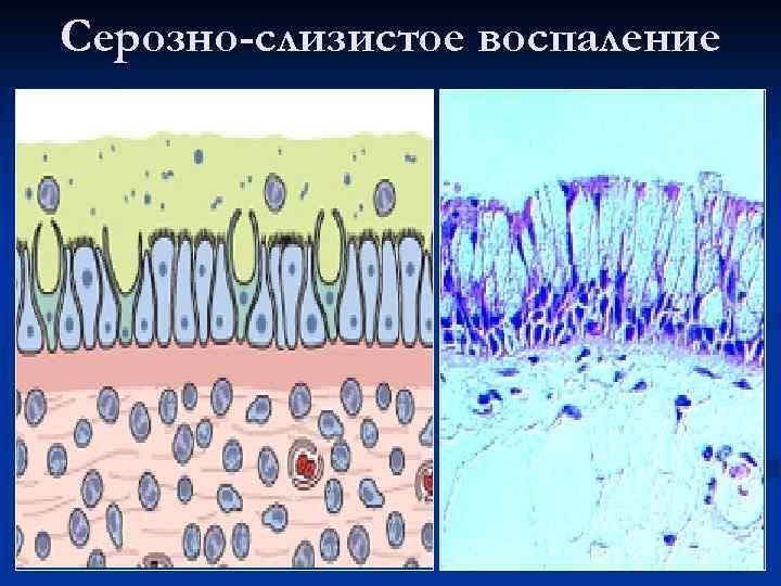 Серозно-слизистое воспаление 