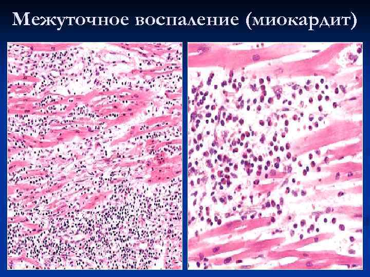 Межуточное воспаление (миокардит) 