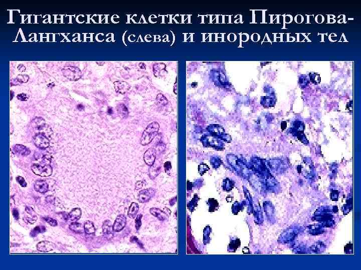 Гигантские клетки типа Пирогова. Лангханса (слева) и инородных тел 