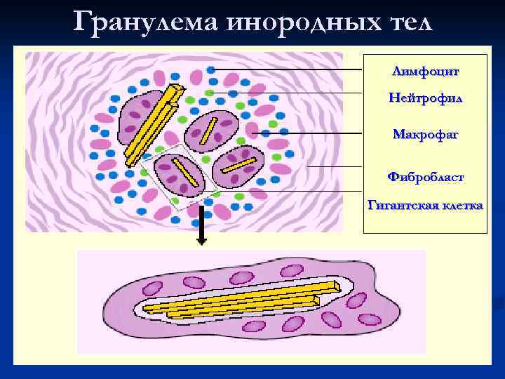 Гранулема инородных тел Лимфоцит Нейтрофил Макрофаг Фибробласт Гигантская клетка 