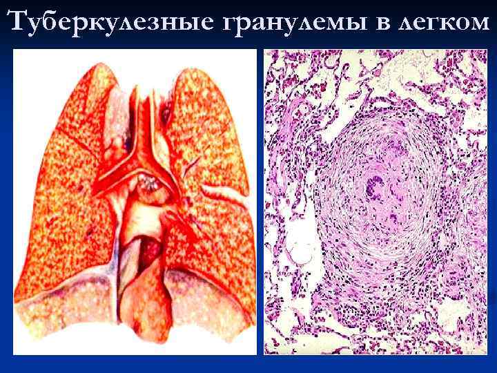 Туберкулезные гранулемы в легком 