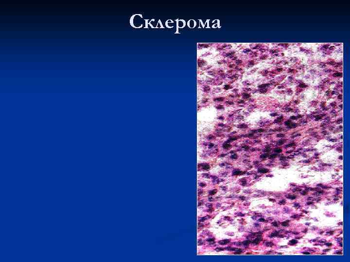 Scleroma