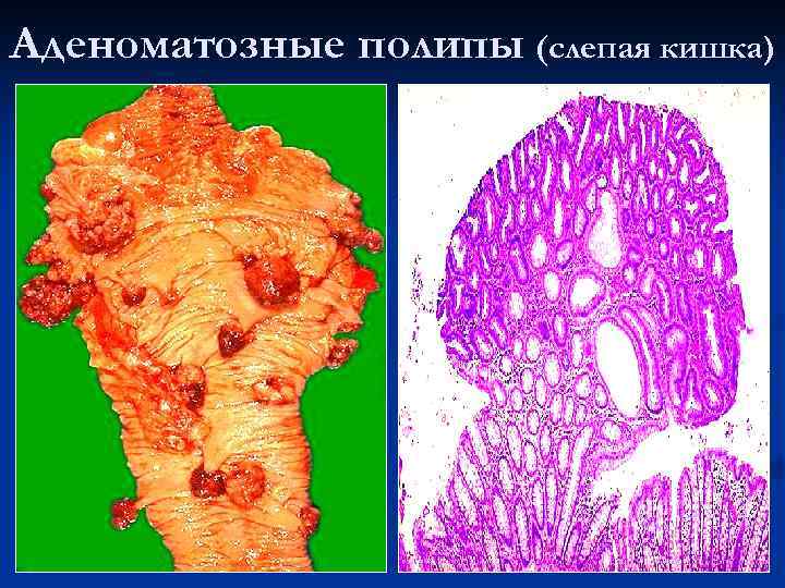 Аденоматозные полипы (слепая кишка) 