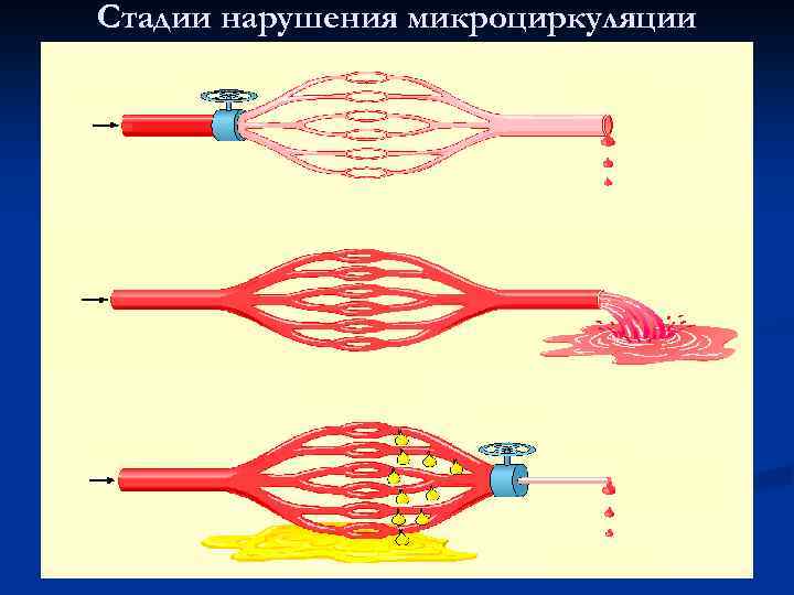 Стадии нарушения микроциркуляции 