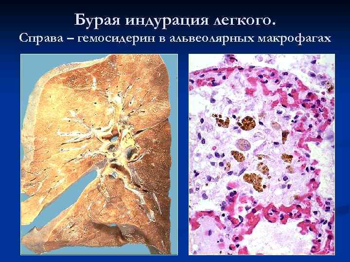 Гемосидероз (бурая индурация). Бурая индурация легких макропрепарат. Бурая индурауция легких Патан. Бурая индурация легкого микропрепарат.