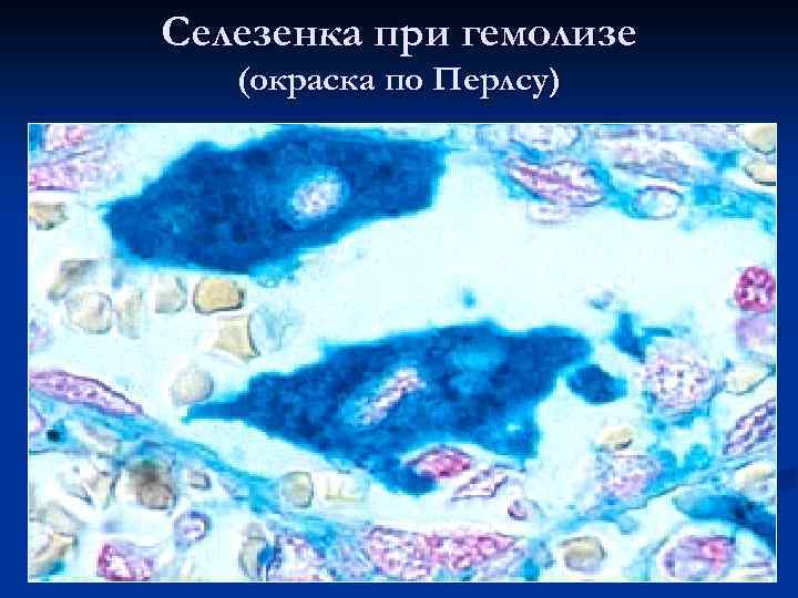 Селезенка при гемолизе (окраска по Перлсу) 