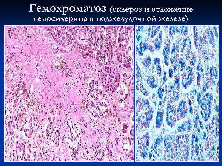 Гемохроматоз (склероз и отложение гемосидерина в поджелудочной железе) 