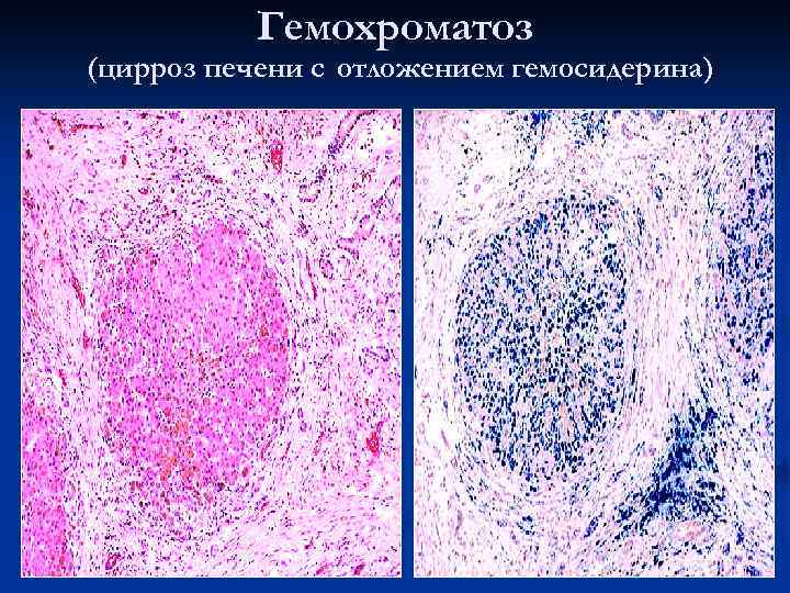 Гемохроматоз (цирроз печени с отложением гемосидерина) 