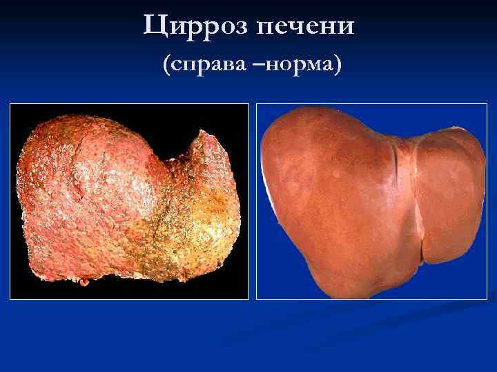 Цирроз печени (справа –норма) 