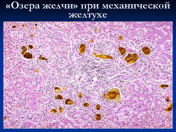  «Озера желчи» при механической желтухе 