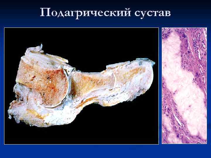 Подагрический сустав 