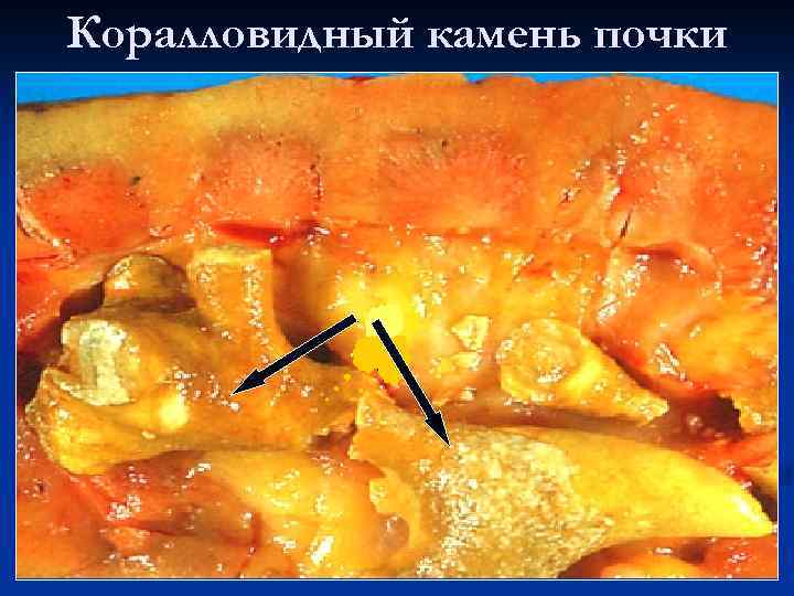 Коралловидный камень почки 