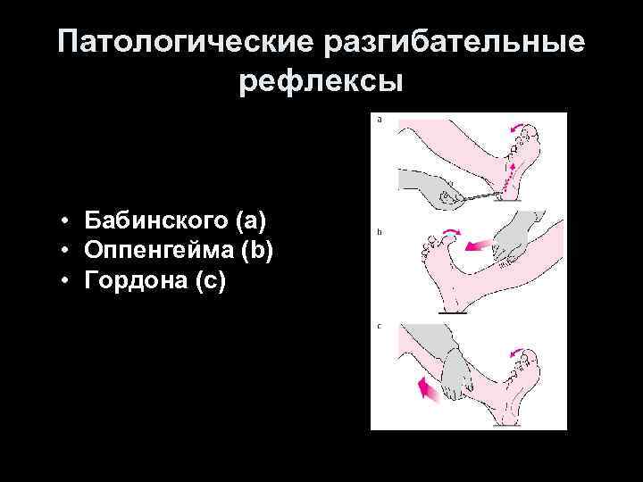 Патологические разгибательные рефлексы • Бабинского (a) • Оппенгейма (b) • Гордона (c) 