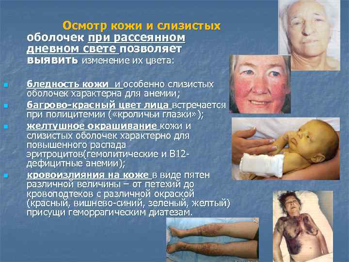 Осмотр кожи и слизистых оболочек при рассеянном дневном свете позволяет выявить изменение их цвета: