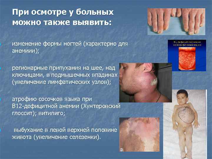 n n При осмотре у больных можно также выявить: изменение формы ногтей (характерно для