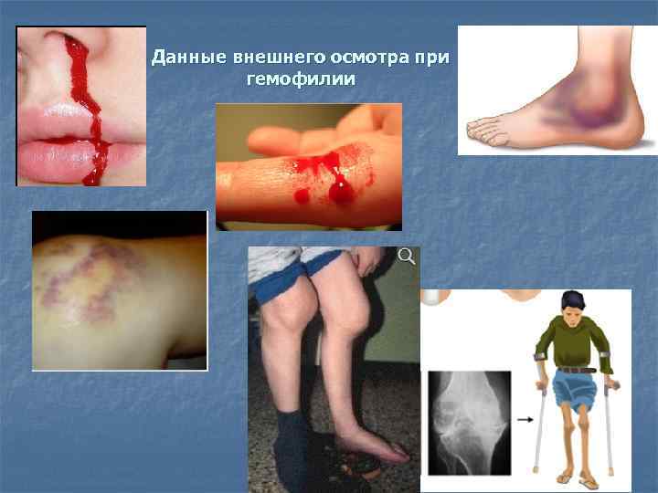 Данные внешнего осмотра при гемофилии 