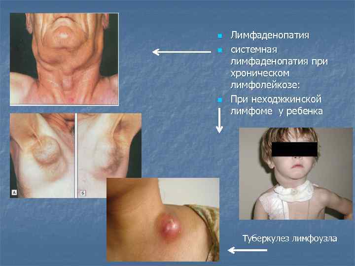 n n n Лимфаденопатия системная лимфаденопатия при хроническом лимфолейкозе: При неходжкинской лимфоме у ребенка