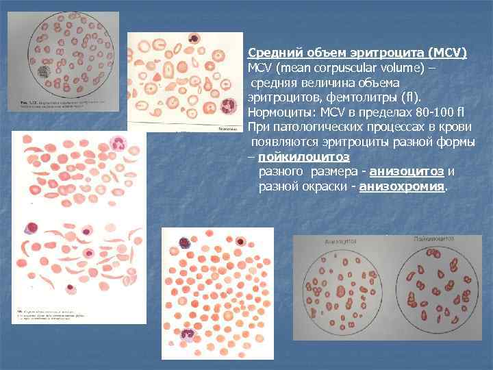 Средний объем эритроцита (MCV) MCV (mean corpuscular volume) – средняя величина объема эритроцитов, фемтолитры