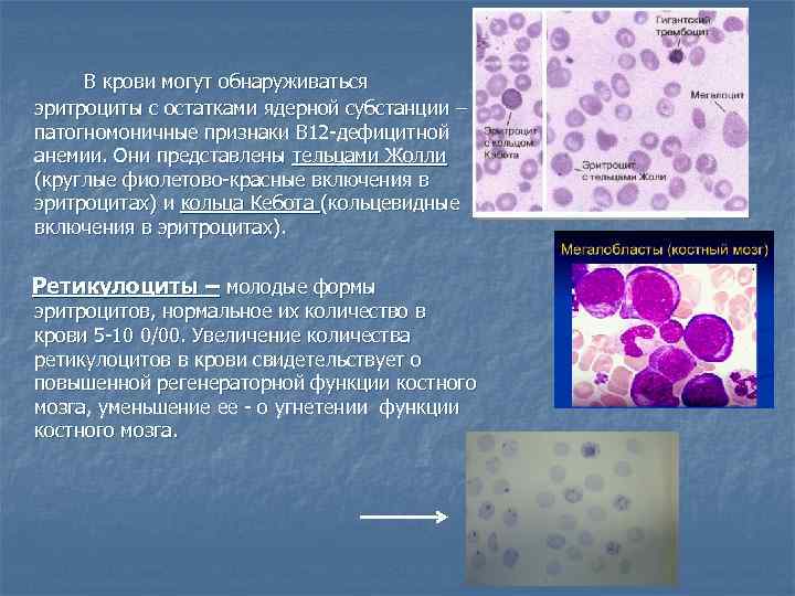 В крови могут обнаруживаться эритроциты с остатками ядерной субстанции – патогномоничные признаки В 12