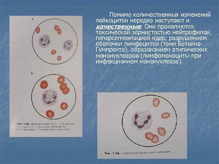 Помимо количественных изменений лейкоцитов нередко наступают и качественные. Они проявляются токсической зернистостью нейтрофилов, гиперсегментацией