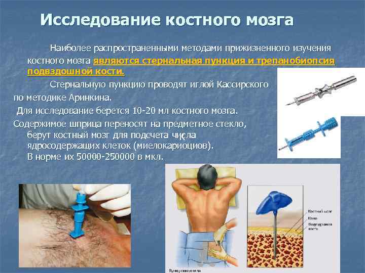 Исследование костного мозга Наиболее распространенными методами прижизненного изучения костного мозга являются стернальная пункция и