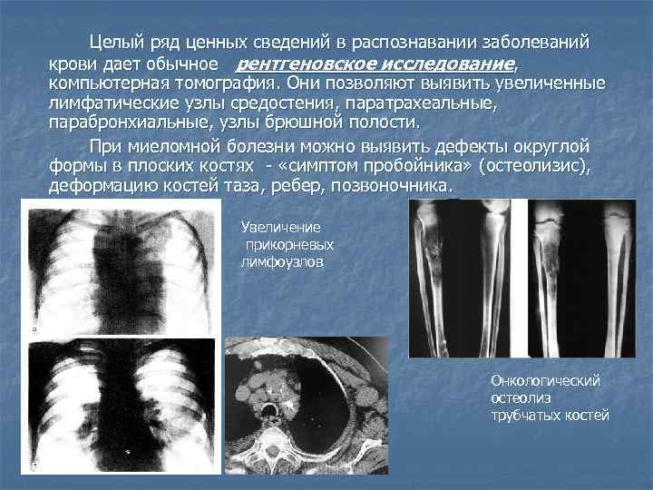 Целый ряд ценных сведений в распознавании заболеваний крови дает обычное рентгеновское исследование, компьютерная томография.
