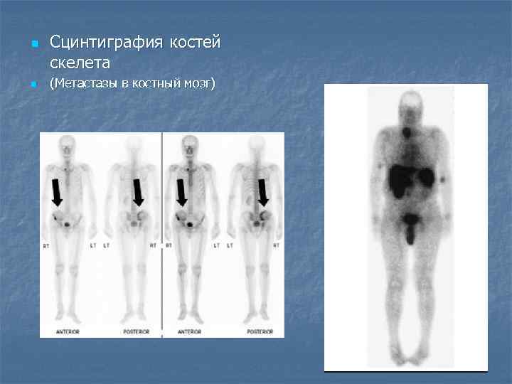 Как выглядят метастазы на костях фото