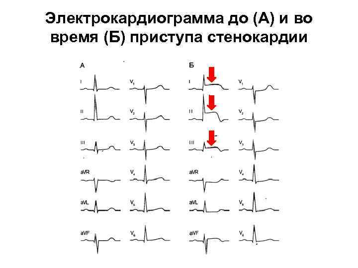 Электрокардиограмма до (А) и во время (Б) приступа стенокардии 