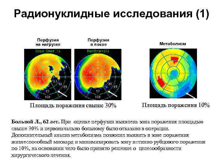Радионуклидные исследования (1) Перфузия на нагрузке Перфузия в покое Площадь поражения свыше 30% Метаболизм