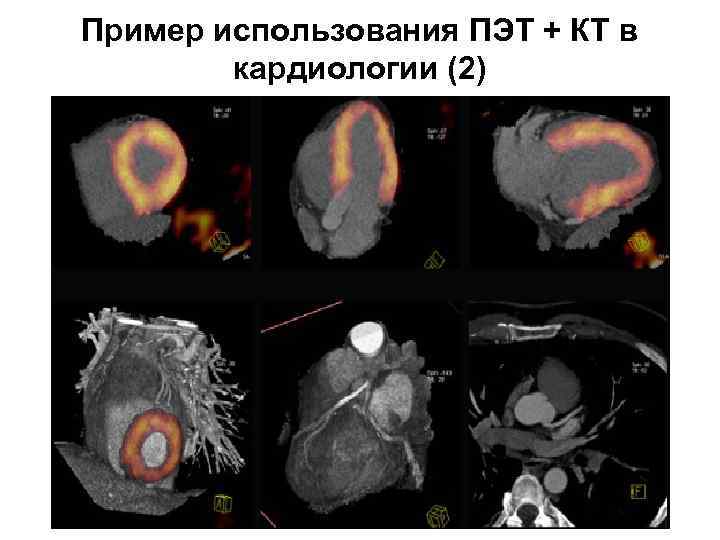 Прогрессирующая стенокардия карта вызова