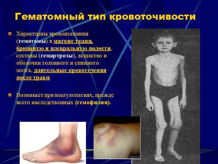 Гематомный тип кровоточивости Характерны кровоизлияния (гематомы) в мягкие ткани, брюшную и плевральную полости, суставы