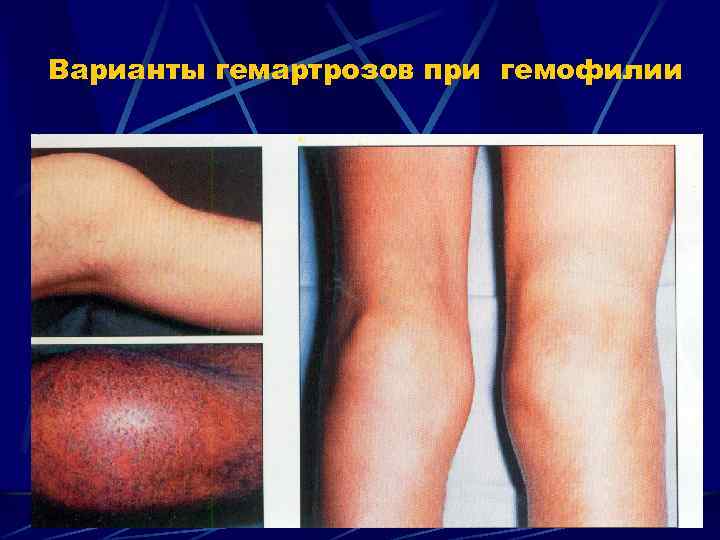 Варианты гемартрозов при гемофилии 