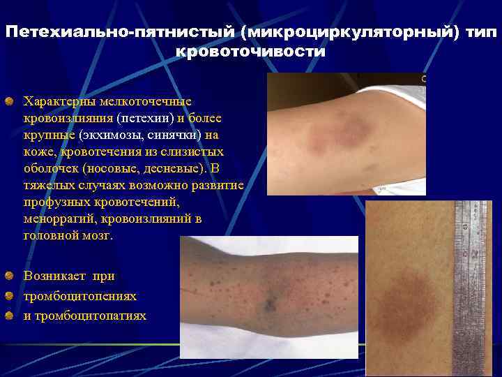 Петехиально-пятнистый (микроциркуляторный) тип кровоточивости Характерны мелкоточечные кровоизлияния (петехии) и более крупные (экхимозы, синячки) на