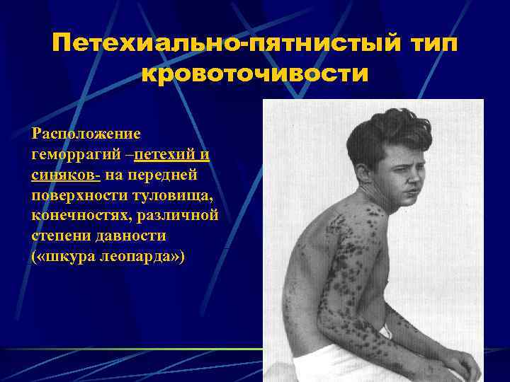 Петехиально-пятнистый тип кровоточивости Расположение геморрагий –петехий и синяков- на передней поверхности туловища, конечностях, различной