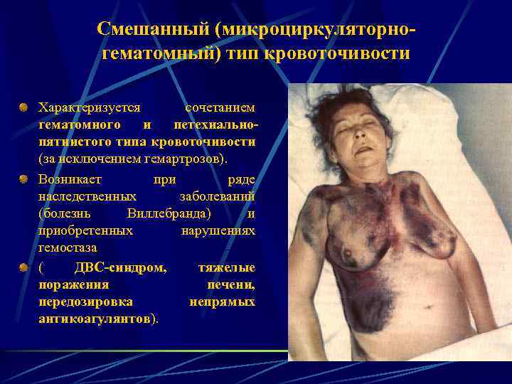 Смешанный (микроциркуляторногематомный) тип кровоточивости Характеризуется сочетанием гематомного и петехиальнопятнистого типа кровоточивости (за исключением гемартрозов).