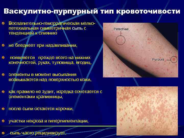 Васкулитно-пурпурный тип кровоточивости Воспалительно-геморрагическая мелкопетехиальная симметричная сыпь с тенденцией к слиянию не бледнеет при